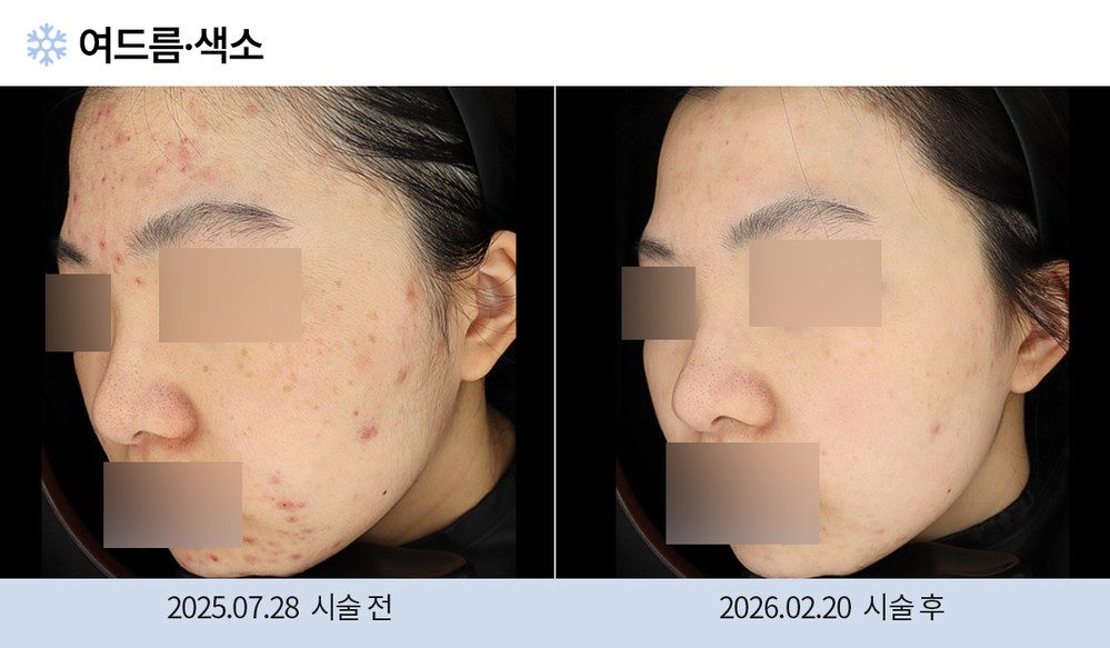 여드름 색소
